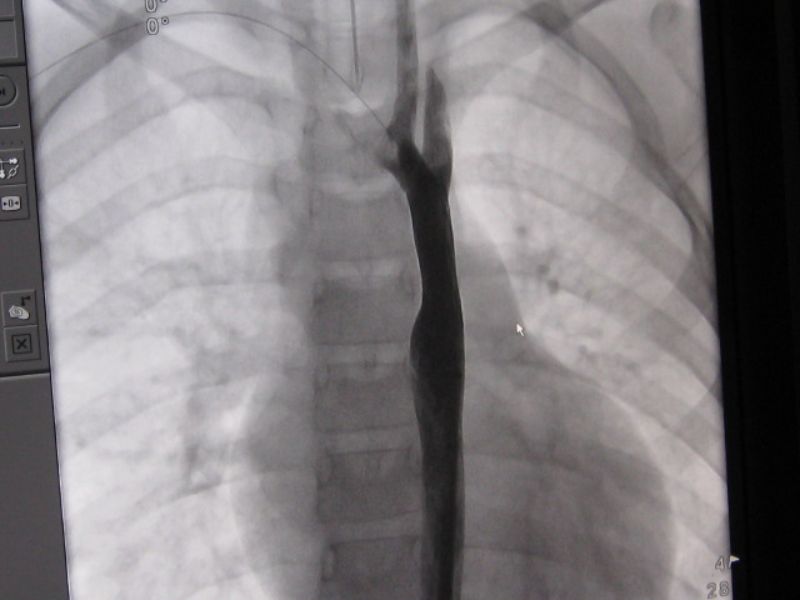 Aorta after.jpg - 44kB